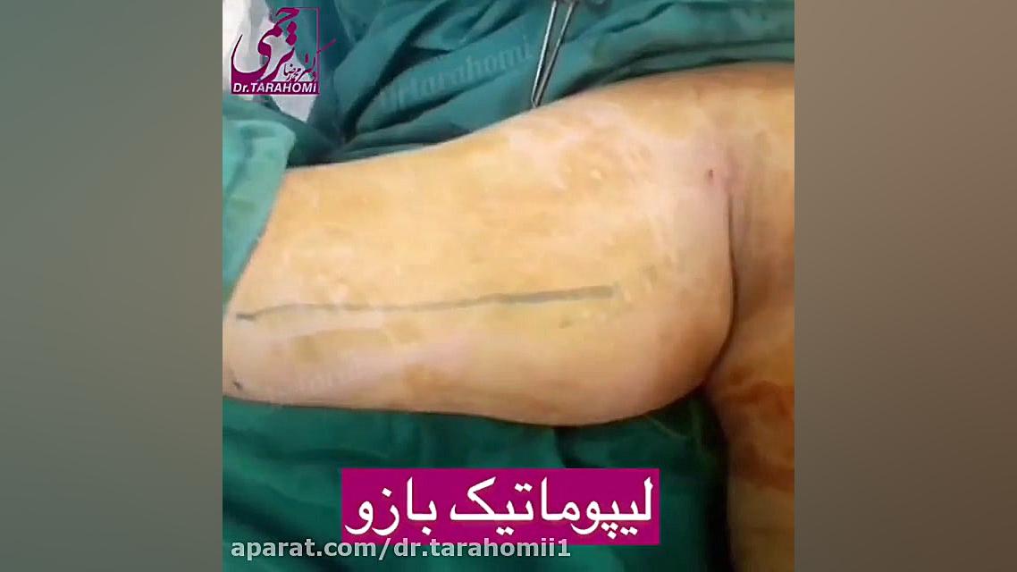نمونه کاری از ليپوماتيك بازو توسط دکترمحمدرضا ترحمی TWA