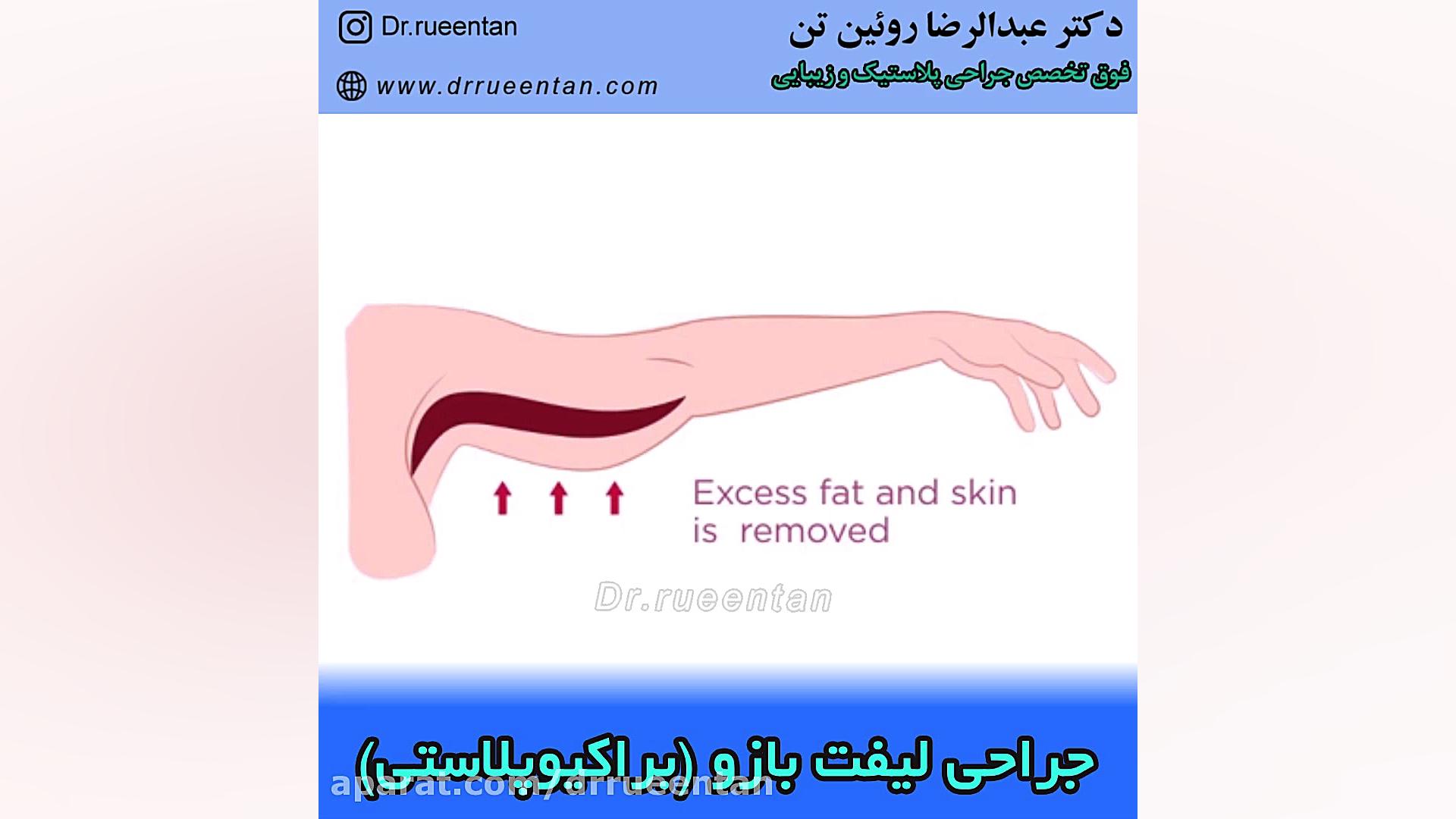 جراحی لیفت بازو دکتر عبدالرضا روئین تن