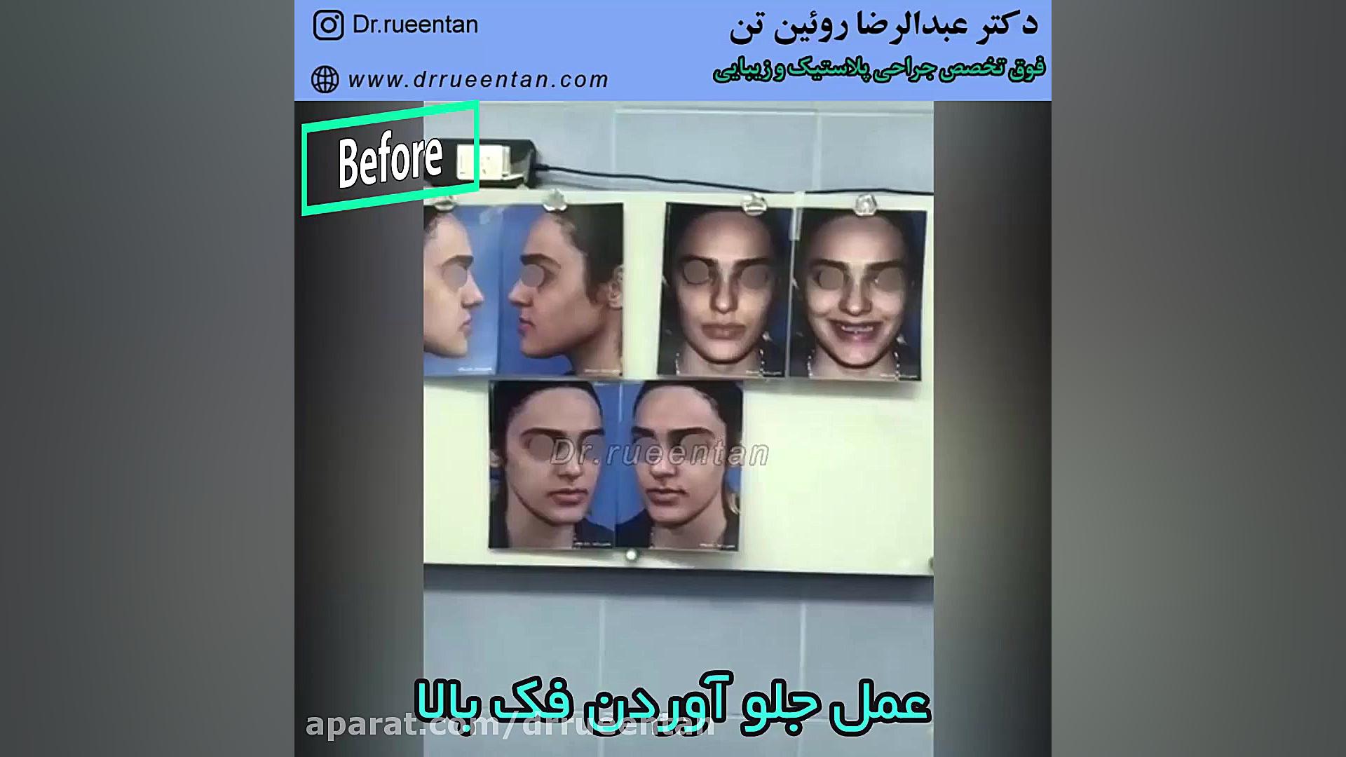 عمل جلو آوردن فک بالا دکتر عبدالرضا روئین تن