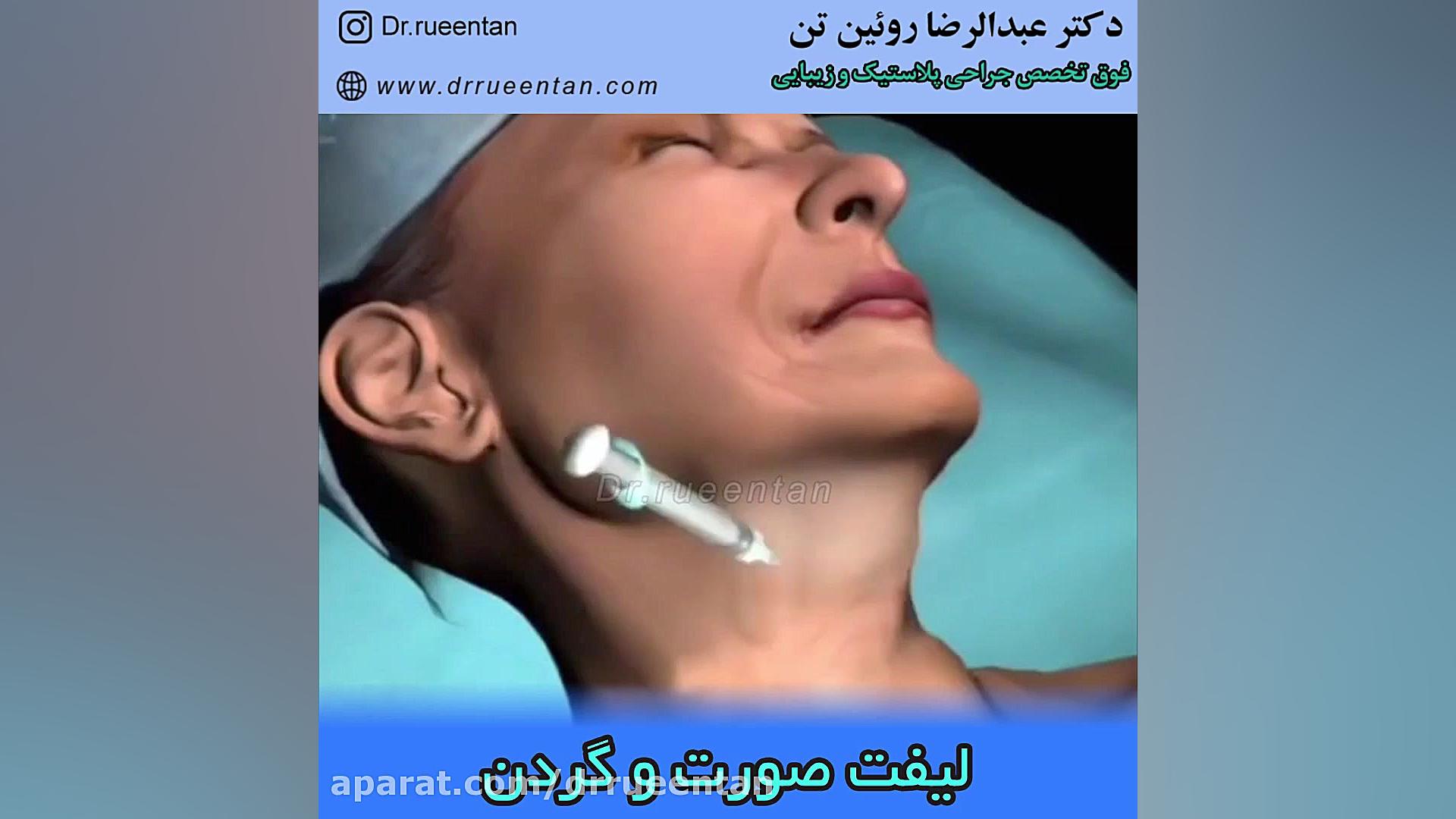 لیفت صورت و گردن پزشکی زیرآب
