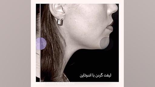 لیفت گردن با اندوتاین اولتراسوند پرتابل جیبی