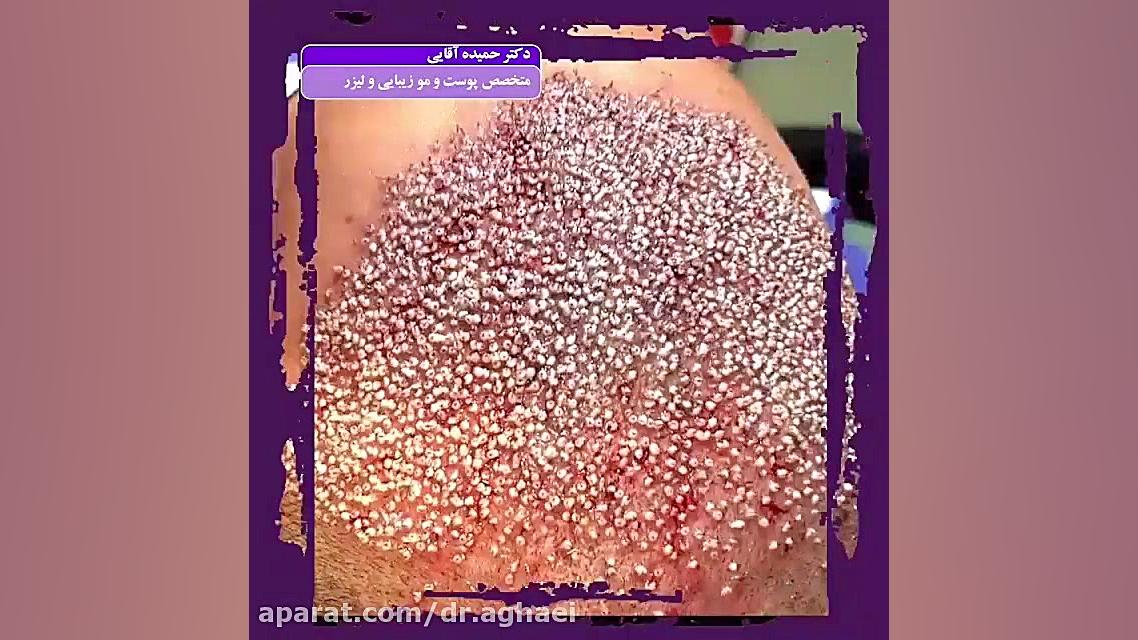 کاشت مو دکتر حمیده آقایی