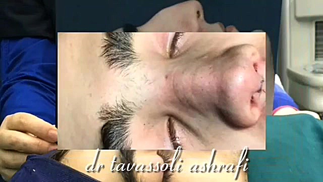 جراحی زیبایی بینی جراحی بینی دکتر احمد توسلی اشرفی