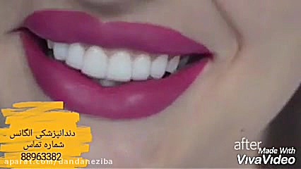 بریج دندان چیست | روکش دندان | کامپوزیت دندان | لمینیت دندان GRO-Seq