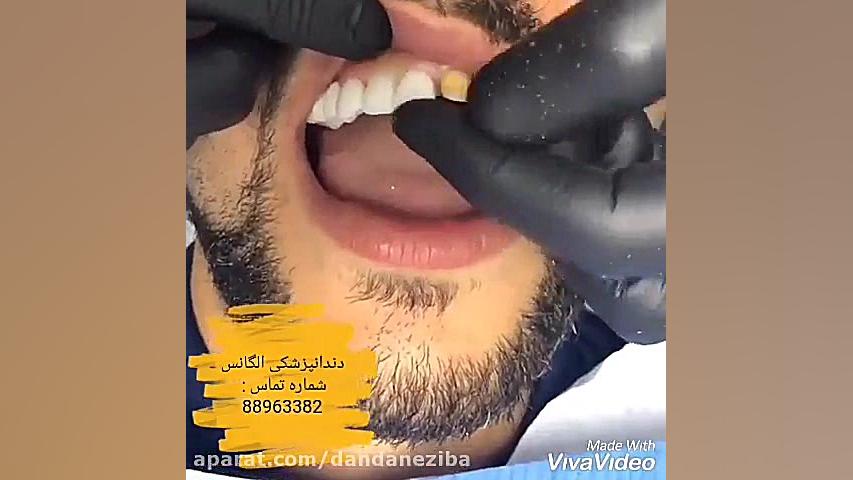 قیمت ایمپلنت دندان | مراحل ایمپلنت کردن دندان | فیلم ایمپلنت کردن دندان گلوسودینیا