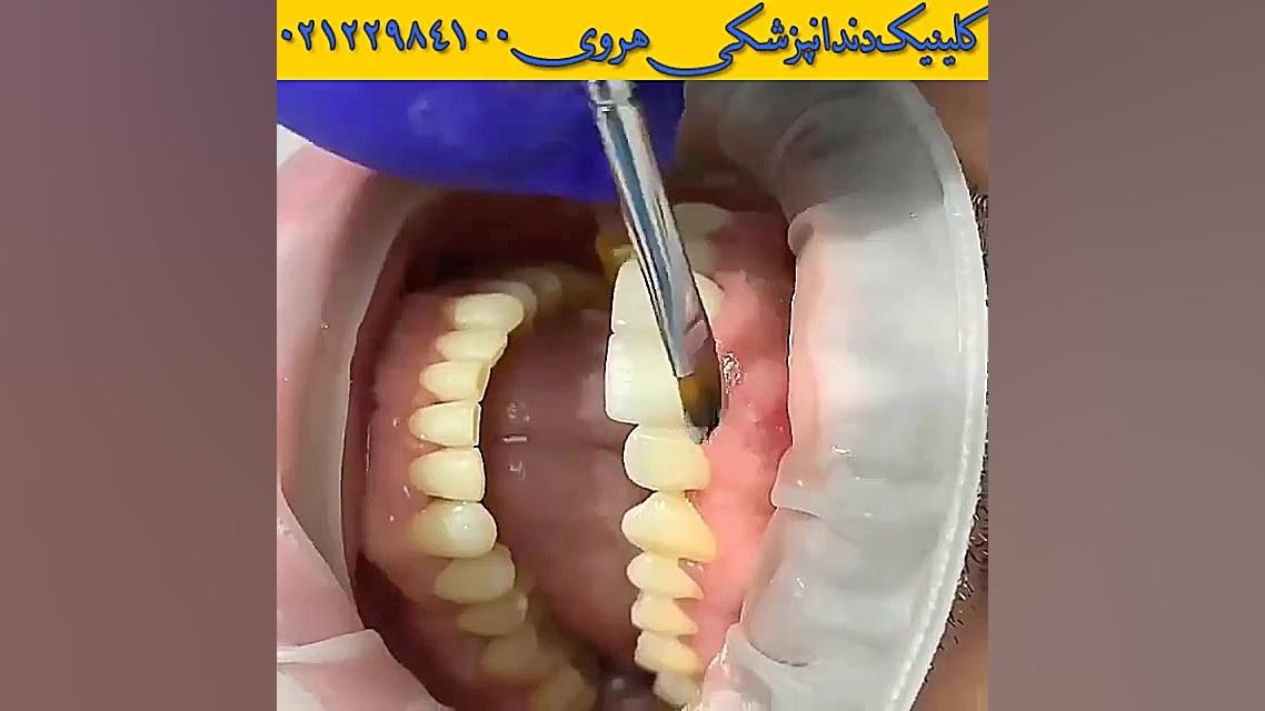 نحوه نصب و چسباندن لمینت روی دندان و زیبایی دندان ها پزشکی درد مداوم