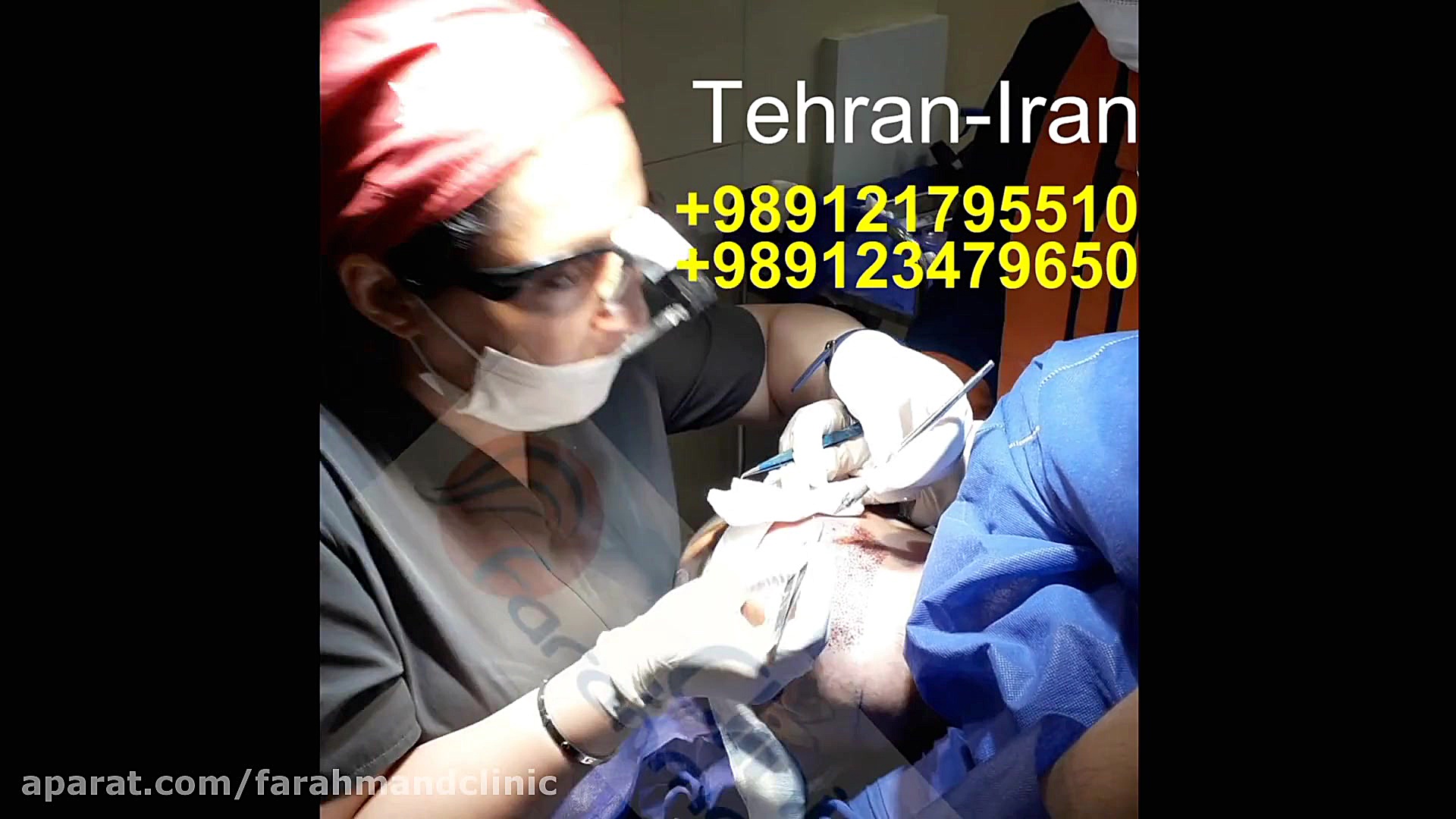 کاشت ریش طبیعی لیزر فرکشنال