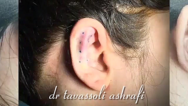 دکتر احمد توسلی اشرفی جراحی بینی دکتر احمد توسلی اشرفی