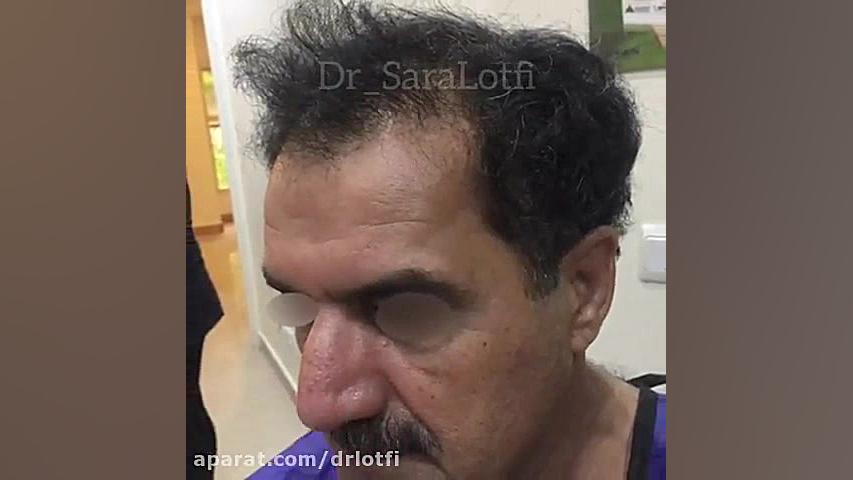 فیلم کاشت مو دکتر سار ا لطفی