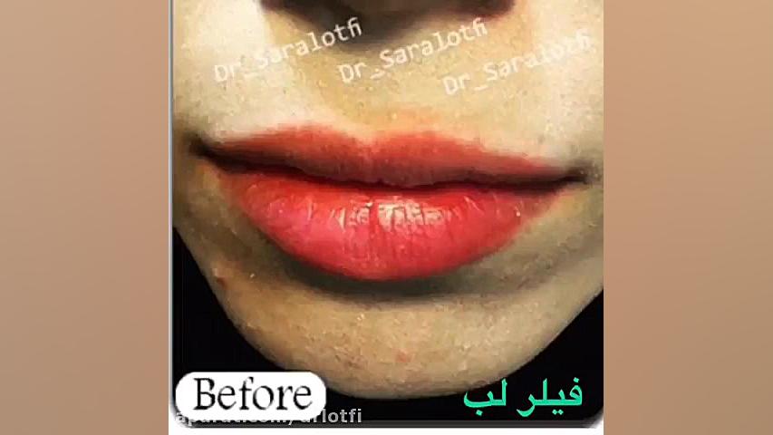 تزریق فیلر لب توسط دکتر سارا لطفی دکتر سار ا لطفی