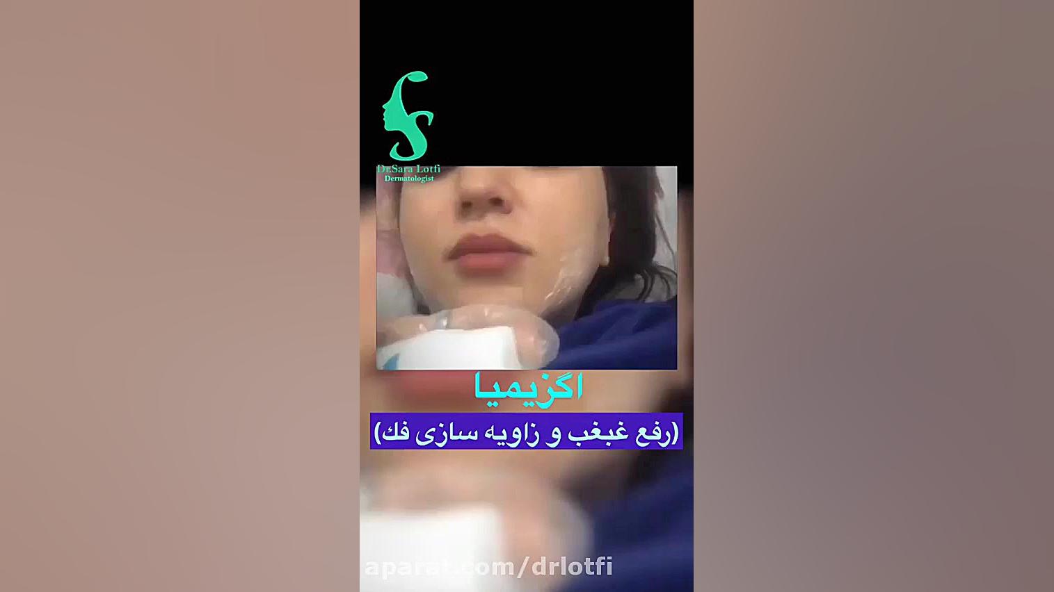 اگزیمیا یا رفع غبغب و زاویه سازی فک دکتر سار ا لطفی