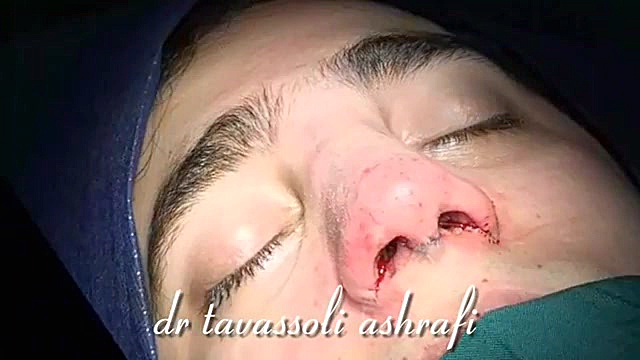 جراحی زیبایی بینی جراحی بینی دکتر احمد توسلی اشرفی