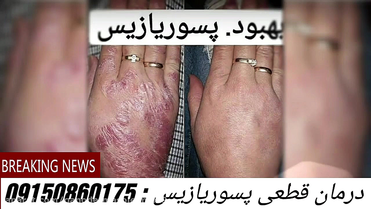 کشف داروی جدید درمان پسوریازیس و صدف..... دکتر سلیمانی زلاتان ابراهیموویچ
