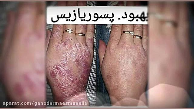 بهترین راه درمان بیماری پسوریازیس چگونه است یوتیوبر کله‌پوک