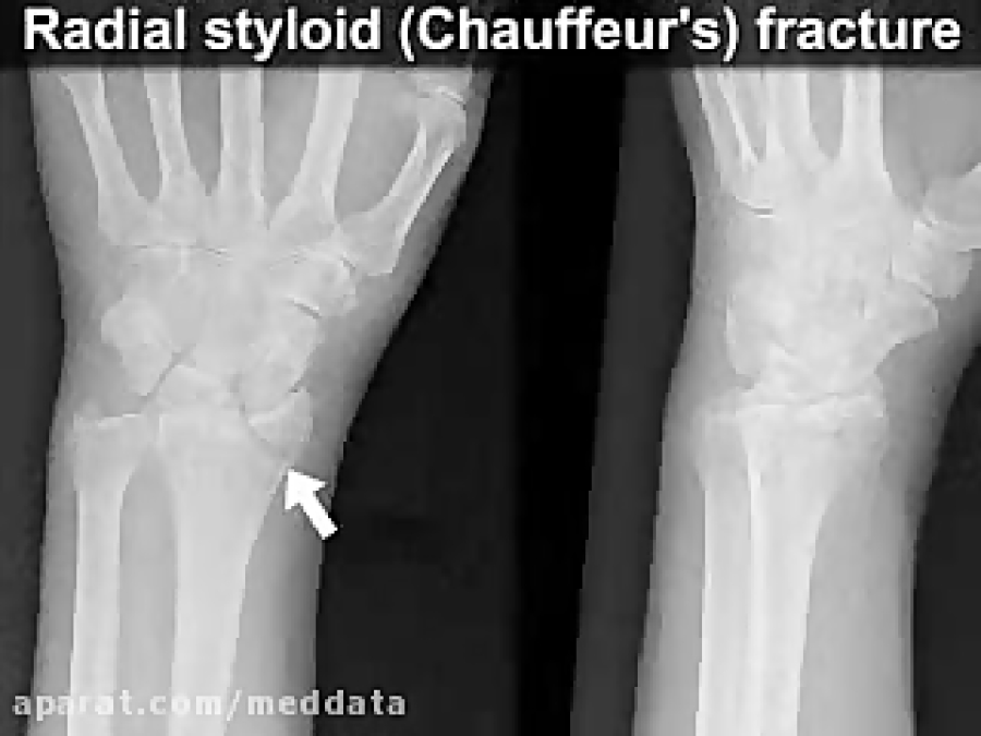 Forearm sugartong splinT
