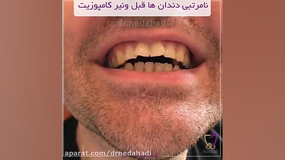 فیلم نمونه کار ونیر کامپوزیت دکتر ندا هادی-دندانپزشک زیبایی