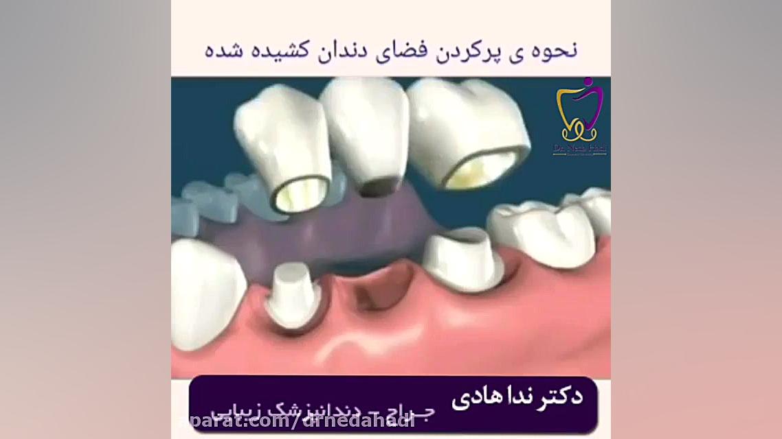 فیلم پر کردن فضای خالی دندان ها دکتر ندا هادی-دندانپزشک زیبایی