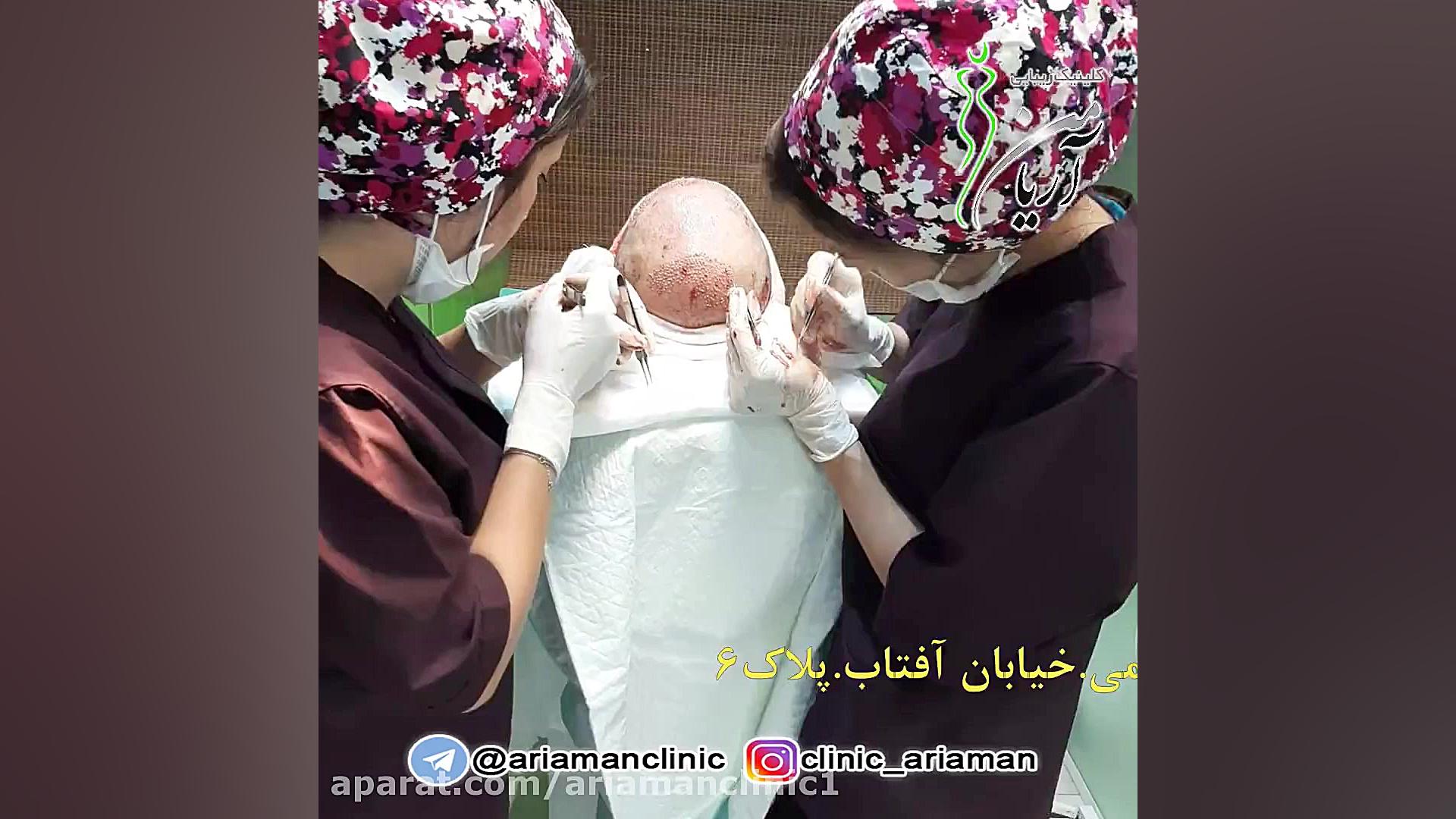 فیلم کامل عمل کاشت مو در کلینیک کاشت مو و زیبایی آریامن لیفت گردنایمپلنت دندان
