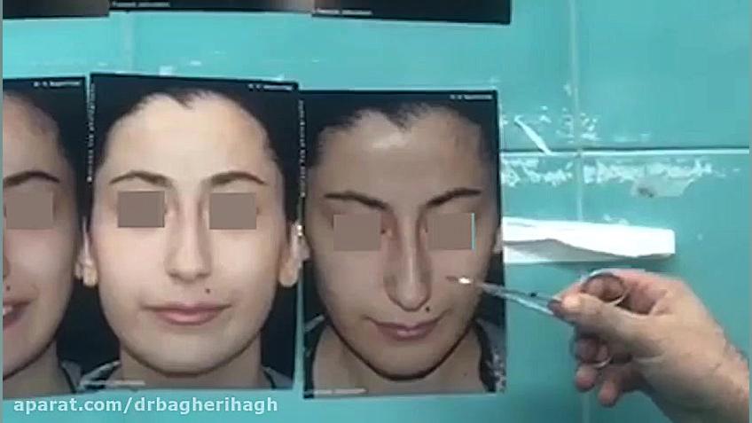 انتهای عمل جراحی بینی دکتر علی باقری حق