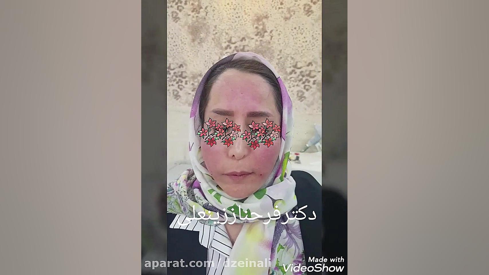 جوانی و زیبایی با تزریق چربی از بدن به صورت دکتر فرحناز زینعلی - متخصص پوست، مو، زیبایی زنجان