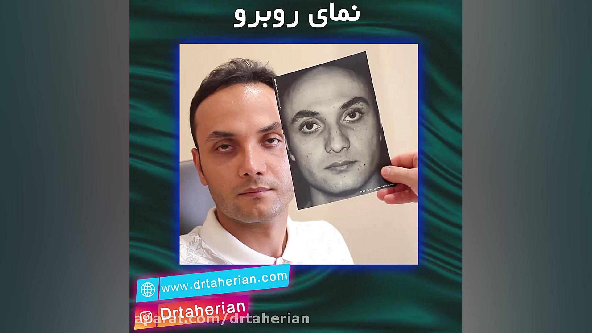 نتیجه عمل زیبایی بینی بعد از شش ماه مایکروگناتیا