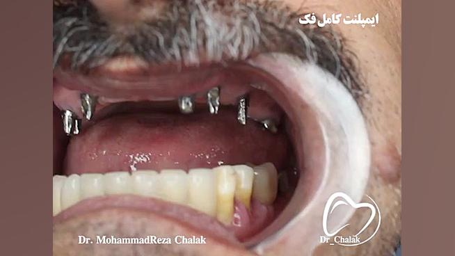 ایمپلنت کامل فک بالا و پایین اونپاترو