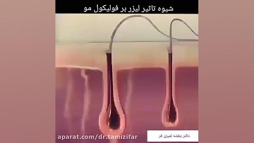 شیوه تاثیر لیزر بر فولیکول مو دکتر بنفشه تمیزی فر