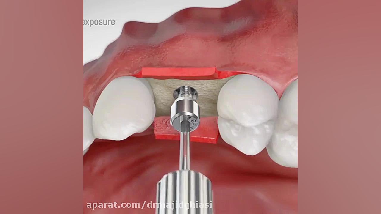 مراحل ایمپلنت دندان -دکترمجیدقیاسی دندانپزشک زیبایی مشهد دکترمجیدقیاسی