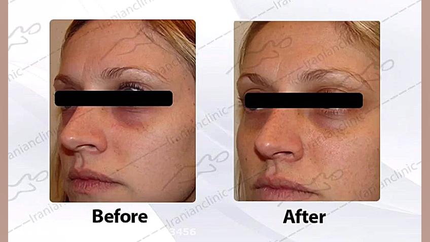 کربوکسی تراپی Carboxy therapy انسریدا