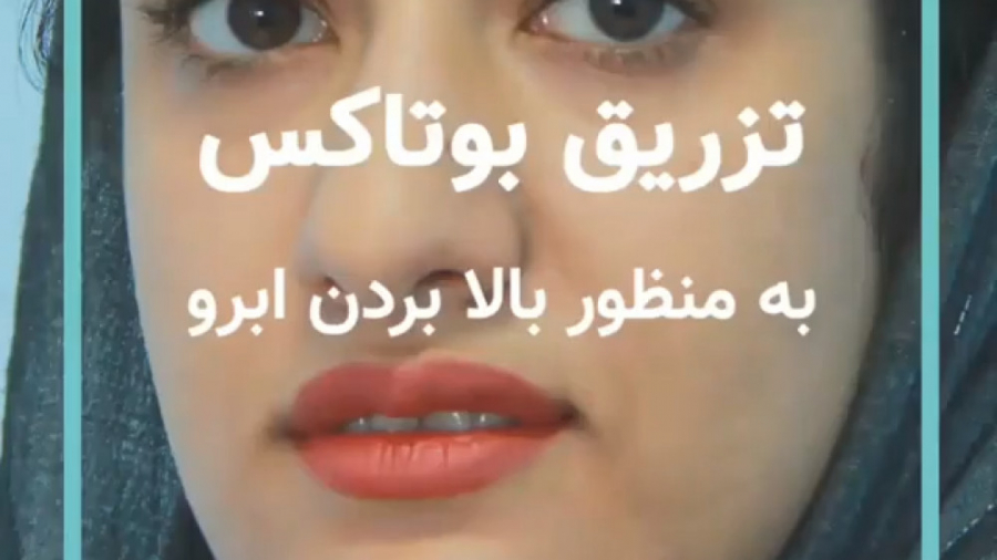 تزریق بوتاکس به منظور بالا بردن ابرو علامت کرنیگ