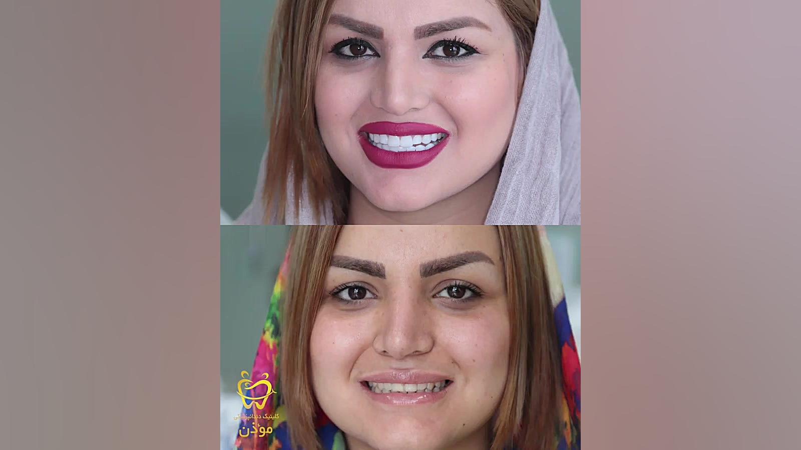 اصلاح خط لبخند-کامپوزیت ونیر تزریق چربی
