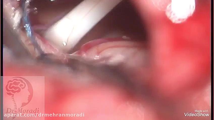 نمونه جراحی اسپاسم همی فاسیال کوبی برایانت