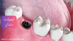 ایمپلنت دندان جلو