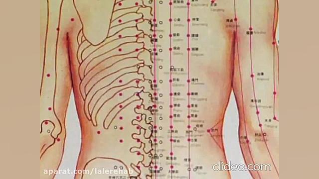 طب سوزنی چیست کلیپ