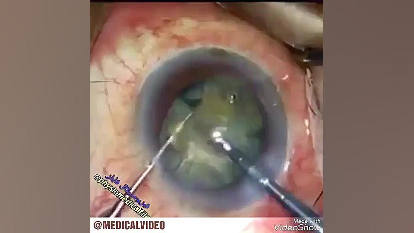 جراحی آب مروارید چشم یا کاتاراکت کاشت ابرو