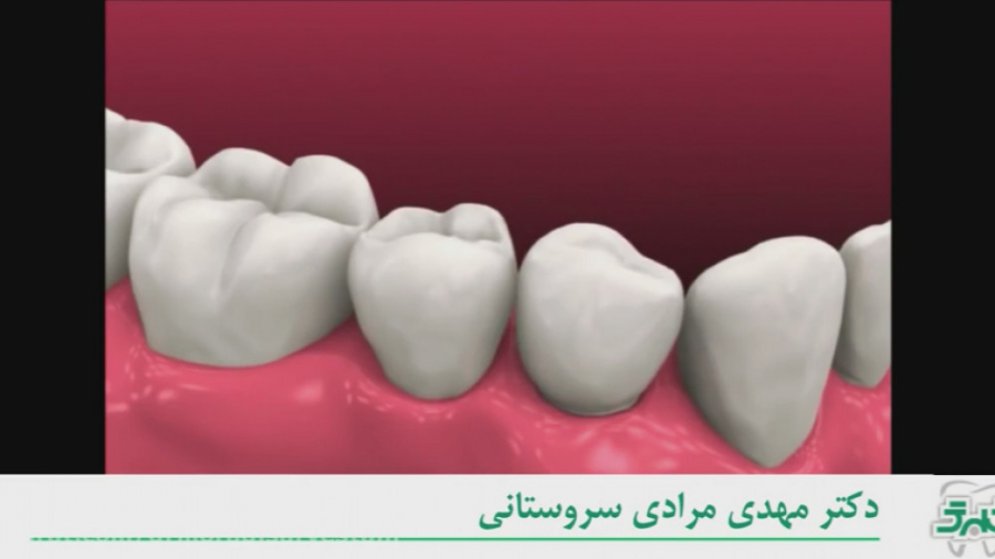 مراحل کامل کاشت دندان یا ایمپلنت دستگاه بیوسنسور عرق
