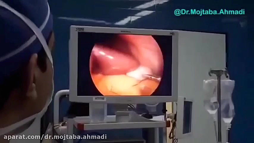 گزارش یک مورد نادر از عمل جراحی اسلیو معده ترمیم سوختگی
