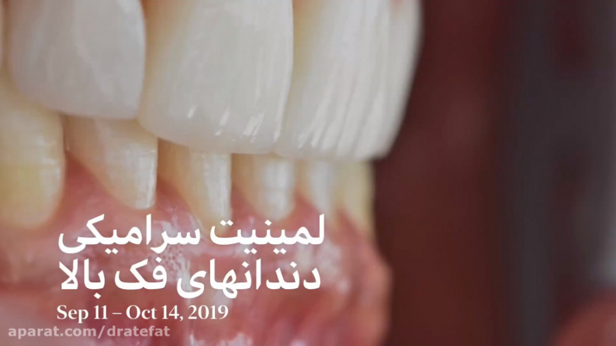 لمینیت سرامیکی دندان های فک بالا اصفهان .دکتر محمد عاطفت متخصص ترمیمی زیبایی دکتر محمد عاطفت متخصص ترمیمی و زیبایی اصفهان