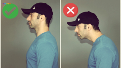 درمان سر رو به جلو