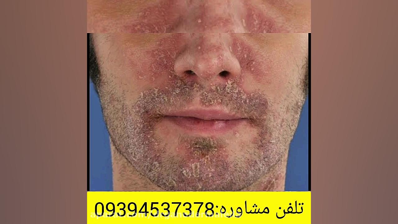 درمان پسوریازیس با طب سنتی جراحی گوش
