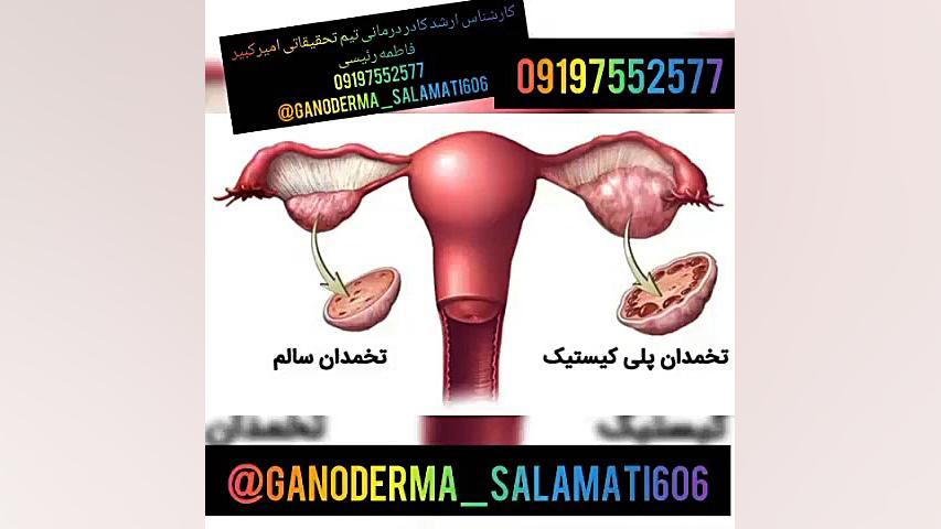 پلی کیستیک تخمدان یا تنبلی تخمدان کلینیک مو