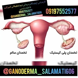 پلی کیستیک تخمدان یا تنبلی تخم...