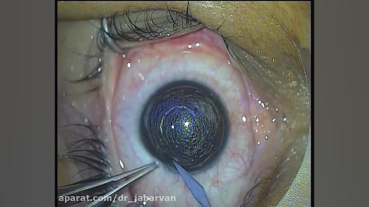AICI Implantation after Keraring دکتر محمود جباروند بهروز