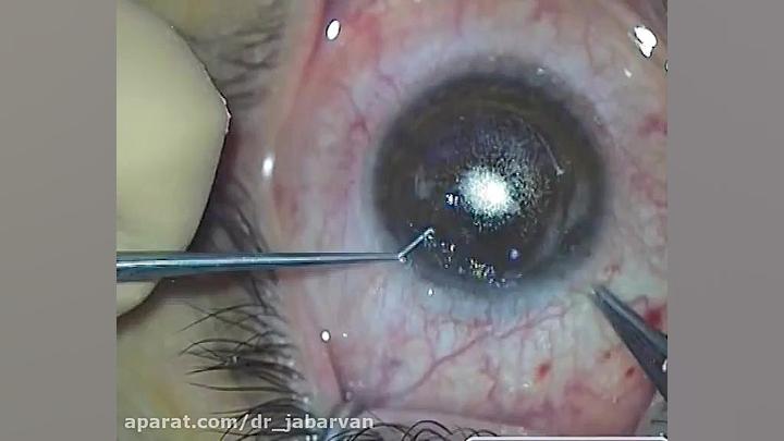 Suction Loss-Entrance Cut دکتر محمود جباروند بهروز