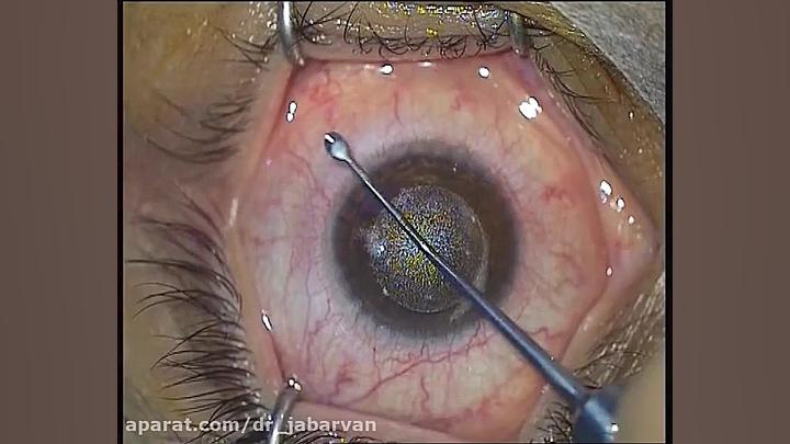 Suction Loss-Incomplete Anterior Plane Cut دکتر محمود جباروند بهروز