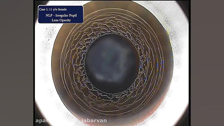 Keratopigmentation-Case 1 دکتر محمود جباروند بهروز