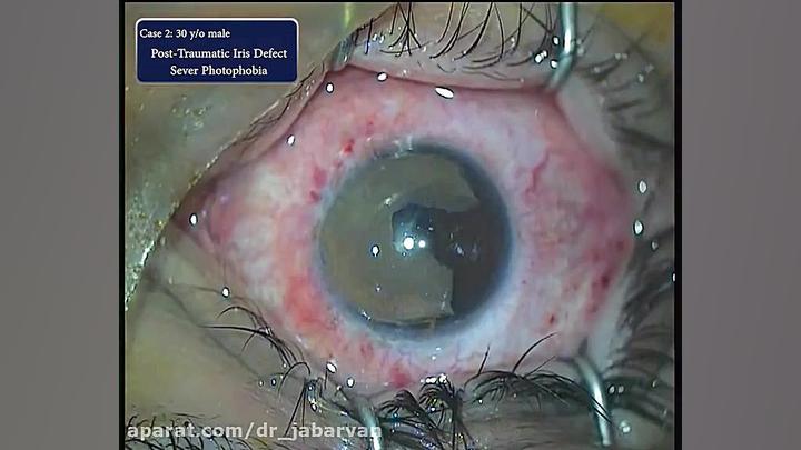 Keratopigmentation-Case 2 دکتر محمود جباروند بهروز