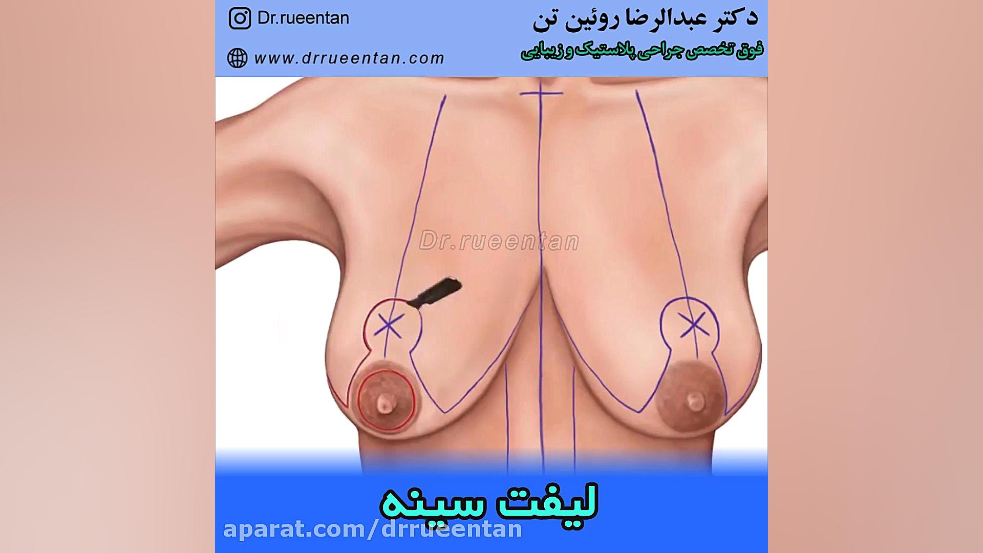 لیفت سینه دکتر عبدالرضا روئین تن