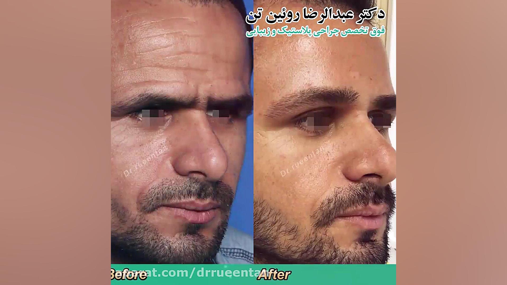 لیفت ابرو و پیشانی دستگاه آنالیز ایمیجینگ سلول زنده