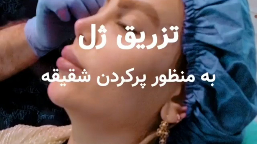 تزریق ژل به منظور پر کردن شقیقه اونپاترو